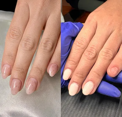Antes y después de una reconstrucción de uñas